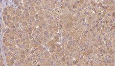 UTS2 / Urotensin II Antibody - 1:100 staining human Melanoma tissue by IHC-P. The sample was formaldehyde fixed and a heat mediated antigen retrieval step in citrate buffer was performed. The sample was then blocked and incubated with the antibody for 1.5 hours at 22°C. An HRP conjugated goat anti-rabbit antibody was used as the secondary.