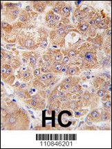 UVRAG Antibody - Formalin-fixed and paraffin-embedded human hepatocarcinoma tissue reacted with hUVRAG (N-term L133), which was peroxidase-conjugated to the secondary antibody, followed by DAB staining. This data demonstrates the use of this antibody for immunohistochemistry; clinical relevance has not been evaluated.