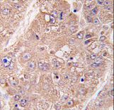 UVRAG Antibody - Formalin-fixed and paraffin-embedded human hepatocarcinoma tissue reacted with hUVRAG , which was peroxidase-conjugated to the secondary antibody, followed by DAB staining. This data demonstrates the use of this antibody for immunohistochemistry; clinical relevance has not been evaluated.