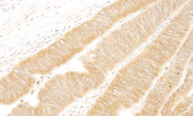 UVRAG Antibody - Detection of Human UVRAG by Immunohistochemistry. Sample: FFPE section of human colon carcinoma. Antibody: Affinity purified rabbit anti-UVRAG used at a dilution of 1:250. Epitope Retrieval Buffer-High pH (IHC-101J) was substituted for Epitope Retrieval Buffer-Reduced pH.