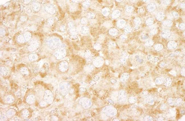 UVRAG Antibody - Detection of Mouse UVRAG by Immunohistochemistry. Sample: FFPE section of mouse renal cell carcinoma. Antibody: Affinity purified rabbit anti-UVRAG used at a dilution of 1:250. Epitope Retrieval Buffer-High pH (IHC-101J) was substituted for Epitope Retrieval Buffer-Reduced pH.