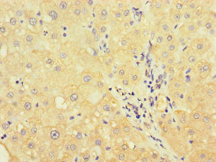 UVRAG Antibody - Immunohistochemistry of paraffin-embedded human liver cancer at dilution of 1:100