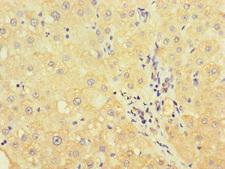 UVRAG Antibody - Immunohistochemistry of paraffin-embedded human liver cancer at dilution of 1:100