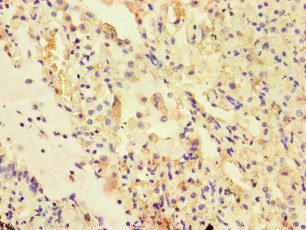 UVRAG Antibody - Immunohistochemistry of paraffin-embedded human lung cancer at dilution of 1:100