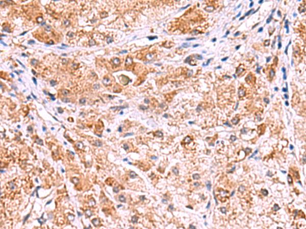 UXS1 Antibody - Immunohistochemistry of paraffin-embedded Human liver cancer tissue  using UXS1 Polyclonal Antibody at dilution of 1:60(×200)