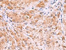 UXS1 Antibody - Immunohistochemistry of paraffin-embedded Human liver cancer tissue  using UXS1 Polyclonal Antibody at dilution of 1:60(×200)