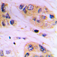 VAMP1+2+3 Antibody - Immunohistochemical analysis of VAMP1/2/3 staining in human prostate cancer formalin fixed paraffin embedded tissue section. The section was pre-treated using heat mediated antigen retrieval with sodium citrate buffer (pH 6.0). The section was then incubated with the antibody at room temperature and detected using an HRP conjugated compact polymer system. DAB was used as the chromogen. The section was then counterstained with hematoxylin and mounted with DPX.