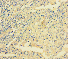 VAMP5 / VAMP-5 Antibody - Immunohistochemistry of paraffin-embedded human lung cancer using VAMP5 Antibody at dilution of 1:100