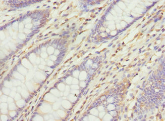 VANGL1 Antibody - Immunohistochemistry of paraffin-embedded human colon cancer at dilution 1:100
