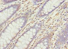 VANGL1 Antibody - Immunohistochemistry of paraffin-embedded human colon cancer at dilution 1:100