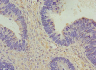 VANGL1 Antibody - Immunohistochemistry of paraffin-embedded human ovarian cancer at dilution 1:100
