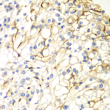 VANGL2 / LTAP Antibody - Immunohistochemistry of paraffin-embedded human kidney cancer tissue.