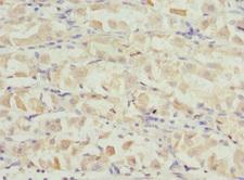 VANGL2 / LTAP Antibody - Immunohistochemistry of paraffin-embedded human gastric cancer at dilution 1:100