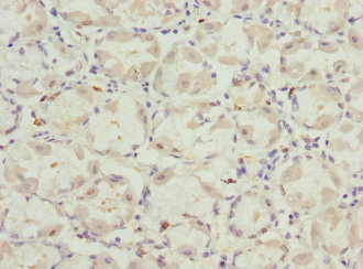 VANGL2 / LTAP Antibody - Immunohistochemistry of paraffin-embedded human gastric cancer at dilution 1:100