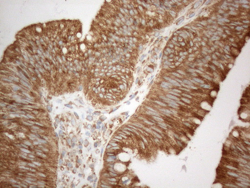 VAP33 / VAPA Antibody - Immunohistochemical staining of paraffin-embedded Carcinoma of Human pancreas tissue using anti-VAPA mouse monoclonal antibody. (Heat-induced epitope retrieval by 1mM EDTA in 10mM Tris buffer. (pH8.5) at 120°C for 3 min. (1:150)