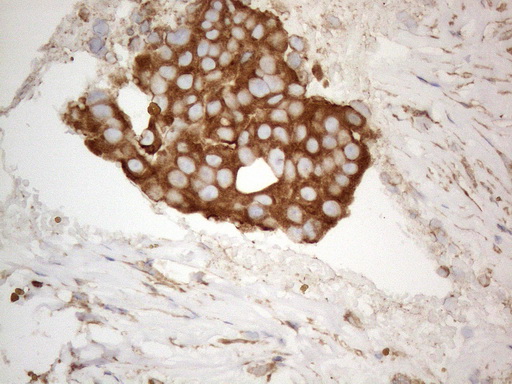 VAP33 / VAPA Antibody - Immunohistochemical staining of paraffin-embedded Adenocarcinoma of Human breast tissue using anti-VAPA mouse monoclonal antibody. (Heat-induced epitope retrieval by 1mM EDTA in 10mM Tris buffer. (pH8.5) at 120°C for 3 min. (1:150)