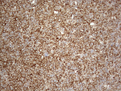 VAP33 / VAPA Antibody - Immunohistochemical staining of paraffin-embedded Human lymphoma tissue using anti-VAPA mouse monoclonal antibody. (Heat-induced epitope retrieval by 1mM EDTA in 10mM Tris buffer. (pH8.5) at 120°C for 3 min. (1:150)