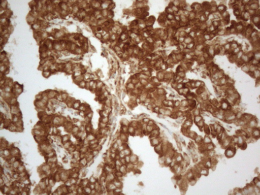 VAP33 / VAPA Antibody - Immunohistochemical staining of paraffin-embedded Carcinoma of Human thyroid tissue using anti-VAPA mouse monoclonal antibody. (Heat-induced epitope retrieval by 1mM EDTA in 10mM Tris buffer. (pH8.5) at 120°C for 3 min. (1:150)