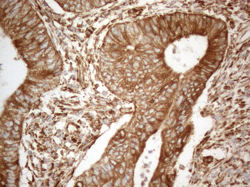 VAP33 / VAPA Antibody - Immunohistochemical staining of paraffin-embedded Adenocarcinoma of Human colon tissue using anti-VAPA mouse monoclonal antibody. (Heat-induced epitope retrieval by 1mM EDTA in 10mM Tris buffer. (pH8.5) at 120°C for 3 min. (1:150)