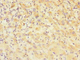 VARS / ValRS Antibody - Immunohistochemistry of paraffin-embedded human lung cancer at dilution 1:100