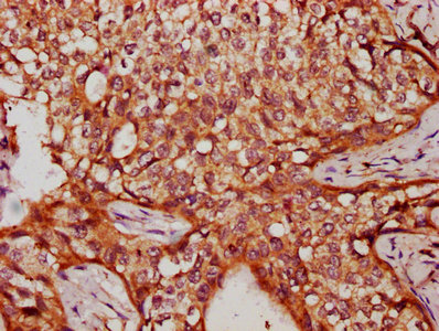 VARS2 / ValRS Antibody - Immunohistochemistry Dilution at 1:300 and staining in paraffin-embedded human cervical cancer performed on a Leica BondTM system. After dewaxing and hydration, antigen retrieval was mediated by high pressure in a citrate buffer (pH 6.0). Section was blocked with 10% normal Goat serum 30min at RT. Then primary antibody (1% BSA) was incubated at 4°C overnight. The primary is detected by a biotinylated Secondary antibody and visualized using an HRP conjugated SP system.