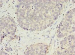 VASH2 Antibody - Immunohistochemistry of paraffin-embedded human gastric cancer using antibody at 1:100 dilution.  This image was taken for the unconjugated form of this product. Other forms have not been tested.