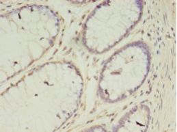 VASH2 Antibody - Immunohistochemistry of paraffin-embedded human colon cancer using antibody at 1:100 dilution.  This image was taken for the unconjugated form of this product. Other forms have not been tested.