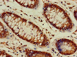 VASH2 Antibody - Immunohistochemistry of paraffin-embedded human colon cancer at dilution of 1:100