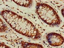 VASH2 Antibody - Immunohistochemistry of paraffin-embedded human colon cancer at dilution of 1:100