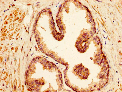 Vasohibin 1 / VASH1 Antibody - IHC image of VASH1 Antibody diluted at 1:500 and staining in paraffin-embedded human prostate cancer performed on a Leica BondTM system. After dewaxing and hydration, antigen retrieval was mediated by high pressure in a citrate buffer (pH 6.0). Section was blocked with 10% normal goat serum 30min at RT. Then primary antibody (1% BSA) was incubated at 4°C overnight. The primary is detected by a biotinylated secondary antibody and visualized using an HRP conjugated SP system.