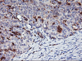 VASP Antibody - IHC of paraffin-embedded Adenocarcinoma of Human ovary tissue using anti-VASP mouse monoclonal antibody.