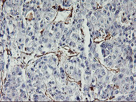 VASP Antibody - IHC of paraffin-embedded Carcinoma of Human liver tissue using anti-VASP mouse monoclonal antibody.