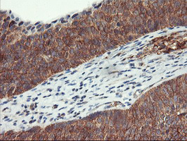 VASP Antibody - IHC of paraffin-embedded Carcinoma of Human bladder tissue using anti-VASP mouse monoclonal antibody.
