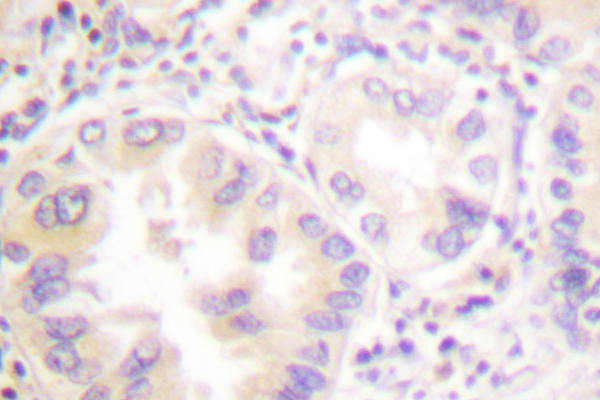 VASP Antibody - IHC of VASP (H150) pAb in paraffin-embedded human lung carcinoma tissue.