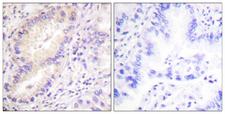 VASP Antibody - Immunohistochemistry of paraffin-embedded human lung carcinoma tissue using VASP (Ab-156) antibody.