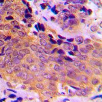 VASP Antibody - Immunohistochemical analysis of VASP (pS157) staining in human breast cancer formalin fixed paraffin embedded tissue section. The section was pre-treated using heat mediated antigen retrieval with sodium citrate buffer (pH 6.0). The section was then incubated with the antibody at room temperature and detected using an HRP conjugated compact polymer system. DAB was used as the chromogen. The section was then counterstained with hematoxylin and mounted with DPX.
