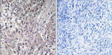 VASP Antibody - Immunohistochemistry of paraffin-embedded human lung carcinoma using VASP (Phospho-Ser157) Antibody.