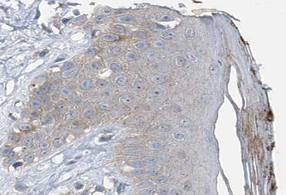 VASP Antibody - 1:100 staining human Skin carcinoma tissue by IHC-P. The tissue was formaldehyde fixed and a heat mediated antigen retrieval step in citrate buffer was performed. The tissue was then blocked and incubated with the antibody for 1.5 hours at 22°C. An HRP conjugated goat anti-rabbit antibody was used as the secondary.