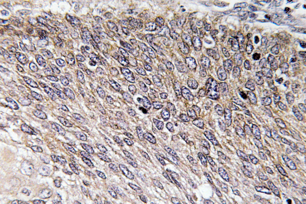 VASP Antibody - IHC of p-VASP (S238) pAb in paraffin-embedded human cervix carcinoma tissue.