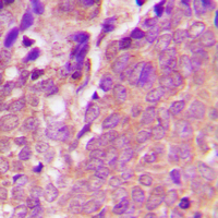 VASP Antibody - Immunohistochemical analysis of VASP (pS238) staining in human breast cancer formalin fixed paraffin embedded tissue section. The section was pre-treated using heat mediated antigen retrieval with sodium citrate buffer (pH 6.0). The section was then incubated with the antibody at room temperature and detected using an HRP conjugated compact polymer system. DAB was used as the chromogen. The section was then counterstained with hematoxylin and mounted with DPX.
