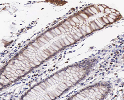 VASP Antibody - 1:200 staining human colon carcinoma tissue by IHC-P. The tissue was formaldehyde fixed and a heat mediated antigen retrieval step in citrate buffer was performed. The tissue was then blocked and incubated with the antibody for 1.5 hours at 22°C. An HRP conjugated goat anti-rabbit antibody was used as the secondary.