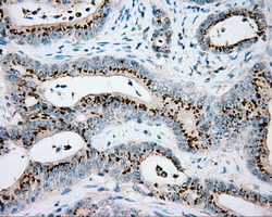 VAT1L Antibody - Immunohistochemical staining of paraffin-embedded Adenocarcinoma of colon tissue using anti-VAT1L mouse monoclonal antibody. (Dilution 1:50).