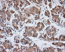 VAT1L Antibody - Immunohistochemical staining of paraffin-embedded Carcinoma of liver tissue using anti-VAT1L mouse monoclonal antibody. (Dilution 1:50).