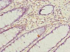 VAT1L Antibody - Immunohistochemistry of paraffin-embedded human colon cancer using antibody at dilution of 1:100.