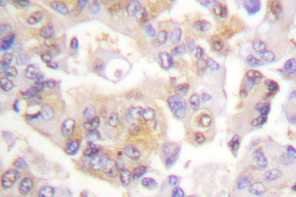 VAV1 / VAV Antibody - IHC of VAV1 (A168) pAb in paraffin-embedded human lung carcinoma breast carcinoma tissue.