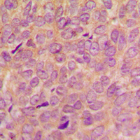 VAV2 Antibody - Immunohistochemical analysis of VAV2 (pY142) staining in human breast cancer formalin fixed paraffin embedded tissue section. The section was pre-treated using heat mediated antigen retrieval with sodium citrate buffer (pH 6.0). The section was then incubated with the antibody at room temperature and detected using an HRP conjugated compact polymer system. DAB was used as the chromogen. The section was then counterstained with hematoxylin and mounted with DPX.