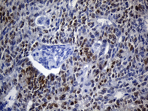 VAX1 Antibody - Immunohistochemical staining of paraffin-embedded Adenocarcinoma of Human endometrium tissue using anti-VAX1 mouse monoclonal antibody. (Heat-induced epitope retrieval by 1mM EDTA in 10mM Tris buffer. (pH8.5) at 120°C for 3 min. (1:150)