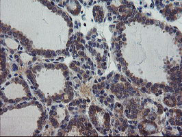 VBP1 Antibody - IHC of paraffin-embedded Carcinoma of Human thyroid tissue using anti-VBP1 mouse monoclonal antibody.