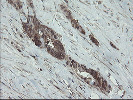 VBP1 Antibody - IHC of paraffin-embedded Adenocarcinoma of Human colon tissue using anti-VBP1 mouse monoclonal antibody. (Heat-induced epitope retrieval by 10mM citric buffer, pH6.0, 100C for 10min).