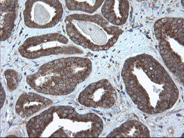 VBP1 Antibody - IHC of paraffin-embedded Carcinoma of Human prostate tissue using anti-VBP1 mouse monoclonal antibody. (Heat-induced epitope retrieval by 10mM citric buffer, pH6.0, 100C for 10min).